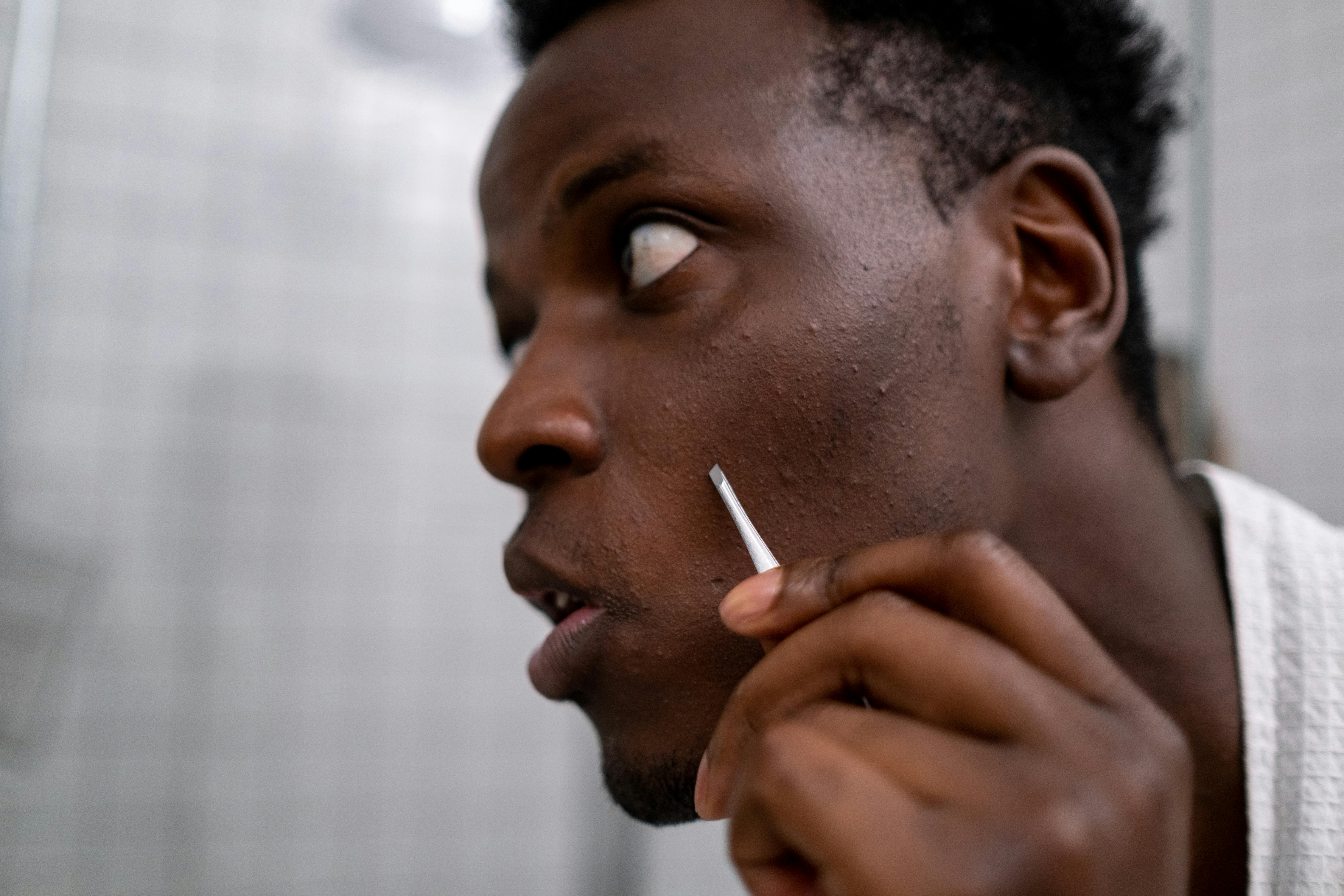 Up close image of a person with acne